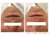 【男性脱毛人気No.1】第一印象アップ脱毛セット（髭＋腕＋脇）￥8500