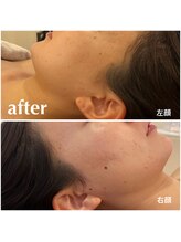 リモアボーテ(RIMOA beaute)/【ニキビ】　after