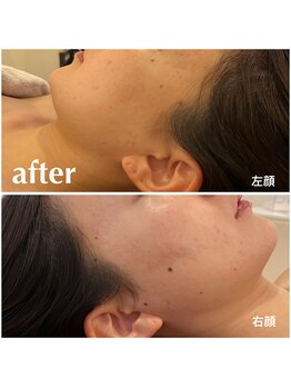 リモアボーテ(RIMOA beaute)/【ニキビ】　after