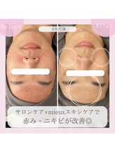ミュー 豊田店(mieux)/◆ニキビケアにはプラセンタ導入