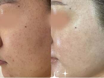 エヌエースキン たまプラーザ店(NAskin)/ハーブピーリング|美白ケア