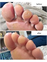 ケアプラス(care plus)/足裏角質ケア
