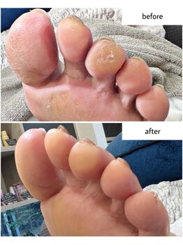 ケアプラス(care plus)/足裏角質ケア