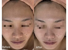 サロン ド ハニー(Salon de Honey)/ハーブピーリング×プラズマ