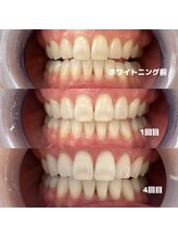 ホワイトニングビューティー 行橋店/ホワイトニング経験者も更に白く