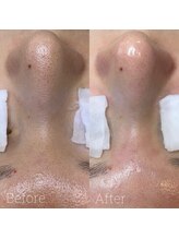 アデュラリアン(Adularian)/毛穴エクストラクション