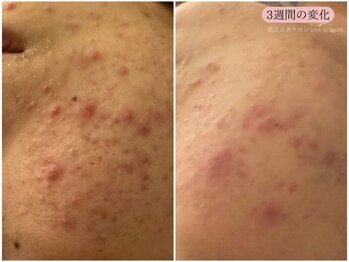 レスイズモア 恵比寿(less is more.)/3週間の変化[はちみつパック付]