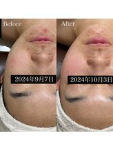 エレガ(ELEGA)/フェイシャルWAX