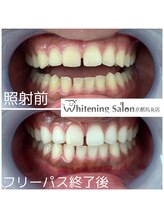 ホワイトニングサロン 京都烏丸店/ホワイトニング施術例
