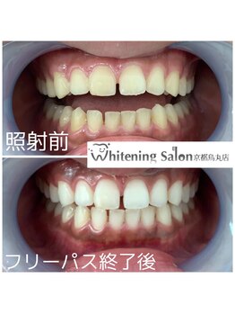 ホワイトニングサロン 京都烏丸店/ホワイトニング施術例