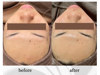 アン ビューティー(ann beauty)/リピーター様 40代女性