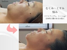 ベリル(BERYL)/むくみくすみ/2回　before after