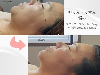 ベリル(BERYL)/むくみくすみ/2回　before after
