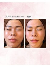 ソワイユ 浜松店(Soyeux)/ 肌質改善　before→after