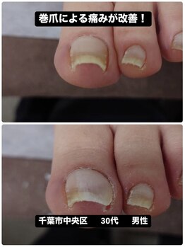 巻き爪による痛みが改善！