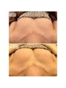 美人バスト 表参道店/バストアップ症例/育乳6回コース