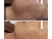 ラシーク(Lasiik)の雰囲気（ラミネーションピールでフェイスラインも変わる！）