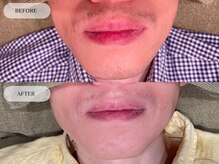 メンズプラス(MEN’S PLUS)/ヒゲ脱毛/ビフォーアフター写真