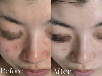 ウィハナ(wehana)/【ララピール】赤み/ニキビ/毛穴