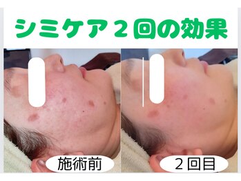 ルナ(Luna)/シミケア効果