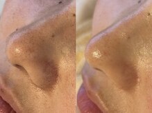 【プラズマニア】頑固な毛穴詰まりスッキリ！毛穴も収縮★