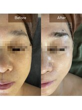 マヴィ(Mavie)/くすみ　Before→After