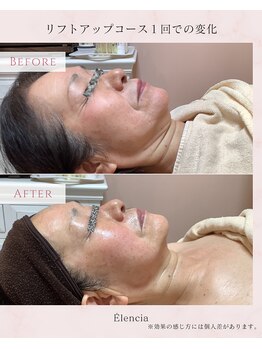エレンシア(E'lencia)/施術効果（Before/After）