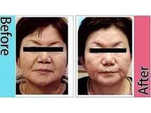 ラヴィアンローズ(LavieenRose)/πセラピー小顔矯正術の効果