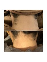 ボンダイボディー(Bondi Body)/うなじ脱毛