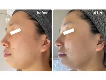 ディアンヌ(Diane)/フェイスライン/ゆがみ/二重あご