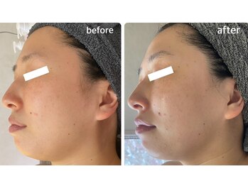 ディアンヌ(Diane)/フェイスライン/ゆがみ/二重あご