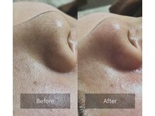 スリース(threes)/鼻の黒ずみケア