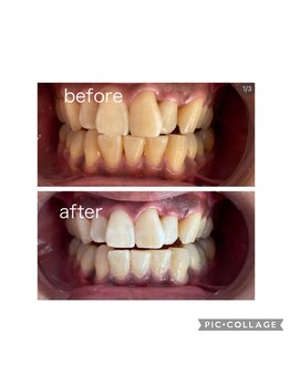 ハラン(haran)/ホワイトニング