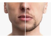 エンユイ 横浜 元町(EnnYui)/美容電気脱毛モニター男女30分☆