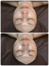 ウララ(ulala)/ララピール1回目