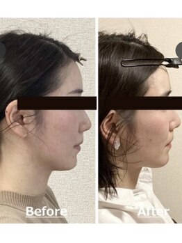 小顔22 ボルティ 本店(Bolty)/小顔シンメトリー矯正&全身矯正