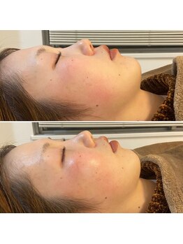 サロン ウェル(SALON WELL)/ 【ハーブピーリング 施術前後】