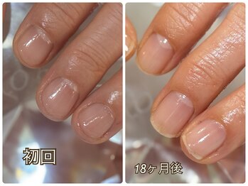 ネイルケア施術経過