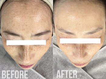 煌(kirameki)/【シミ】毛穴洗浄+micostella