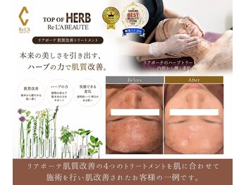ミエル 神戸店(Miel)の写真/【肌質改善サロン】肌荒れやニキビでお悩みの方にお勧め！ファンデーション要らずの綺麗な素肌に♪