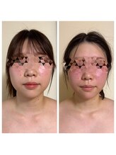 ヨサパーク リアン(YOSA PARK Lien)/モニター様before→after/痩身