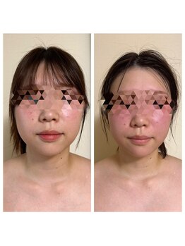 ヨサパーク リアン(YOSA PARK Lien)/モニター様before→after/痩身