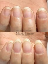 マリーロール 梅田店(Marie Laure)/自爪育成/深爪矯正/ネイルケア