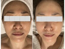 プライベートエステティックサロン クール(Coeur)/【小顔リフトアップコース】