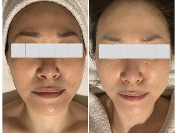 プライベートエステティックサロン クール(Coeur)/【小顔リフトアップコース】