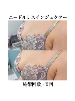 サラ/ニードルレスインジェクター