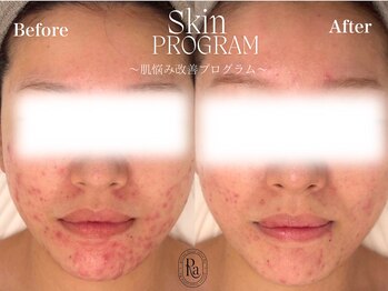 アールエーサロン 恵比寿 広尾(Ra salon)/肌質改善プログラム