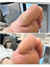 足裏角質ケア