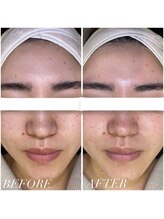 エステプリヴェモロッコ(ESTHE PRIVE MOROCCO)/BIOPHYTO 【毛穴/黒ずみ】