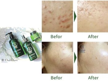 シュシュ 恵比寿店(Chou chou)/毛穴ケア”ハーブピーリング”